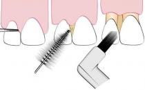 牙齦出血怎么回事？該如何預(yù)防牙齦出血