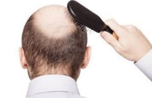想要遠離脫發(fā) 男人應(yīng)做持久戰(zhàn)