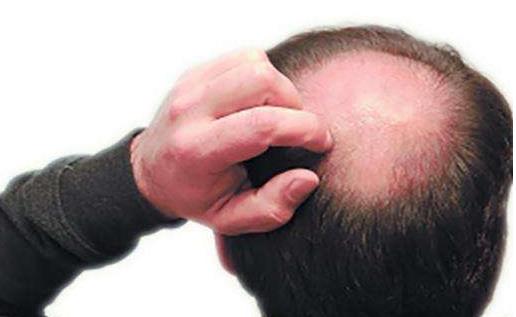 男性治脫發易犯的8大誤區