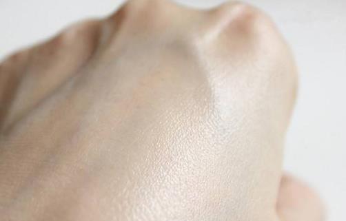 神經性皮炎的癥狀及病因有哪些