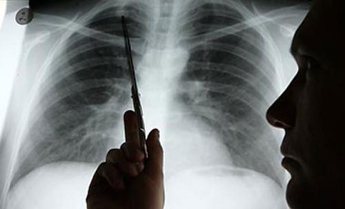 肺癌的早期癥狀有哪些