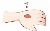 ?燙傷的水泡能挑破嗎 科學處置燒燙傷方法