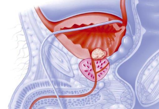 男人冬天容易得前列腺炎的原因 冬天保養尤其重要