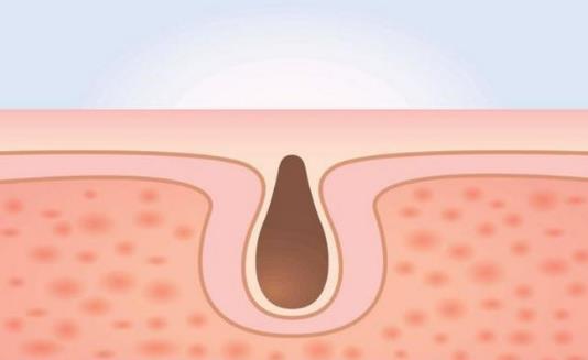 毛孔粗大吃什么好 收縮毛孔最佳飲食營養方案