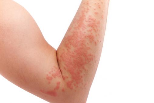 春季易引發(fā)的皮膚病 幾種方法助你輕松應(yīng)對