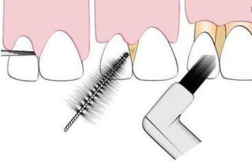 牙齦老出血 是你的身體向你發出警告了