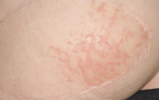 女性保健注意 女性私處易患這4種皮膚病