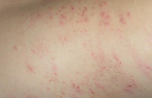 女性保健注意 女性私處易患這4種皮膚病