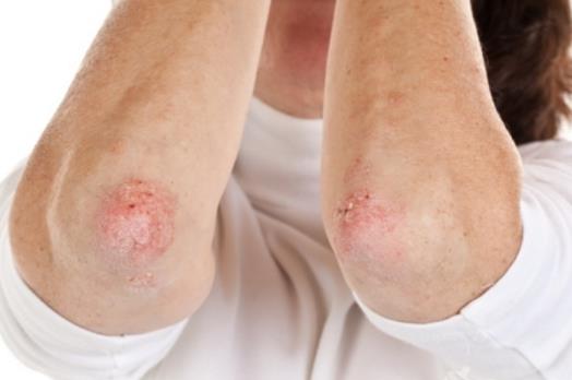 女性保健注意 女性私處易患這4種皮膚病