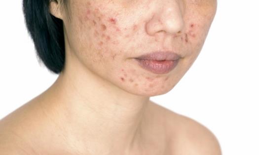 鼻翼兩側長痘 鼻痘的去除方法