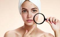 臉上長痘痘究竟是什么原因導致的