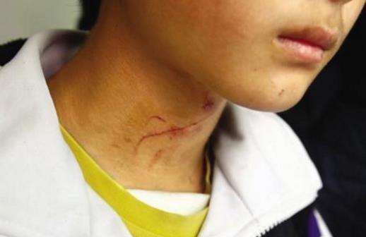 20個生活中的急救常識日常生活中，意外傷害很難避免，有時