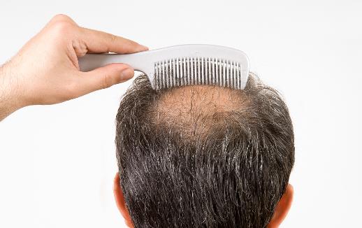 防脫治脫只靠洗護還不夠 頭發(fā)油膩的原因