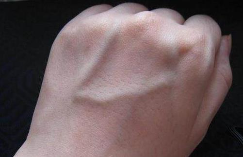 手上青筋說明身體有濕氣 不同部位青筋顯示不同問題