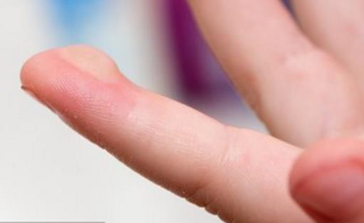 手指無緣無故起小水泡 忌食刺激性食物預防治療水泡