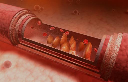 血管變硬竟然是猝死的信號 3步做好動脈硬化的防治