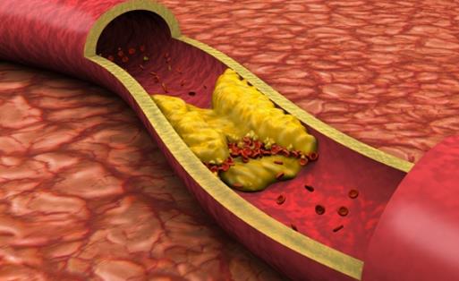 血管變硬竟然是猝死的信號 3步做好動脈硬化的防治