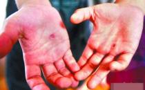 手上長水泡馬上去醫(yī)院 預(yù)防汗皰疹時(shí)的八大注意細(xì)