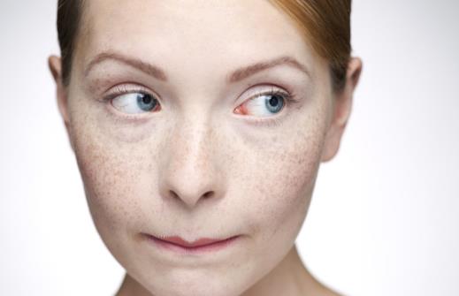 臉上出現雀斑怎么辦 試試這六種祛斑的方法