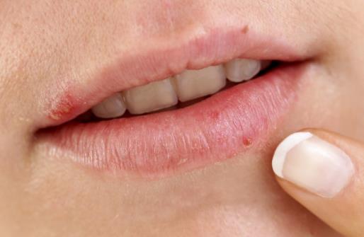 為什么會長唇部皰疹 唇部皰疹怎么治療