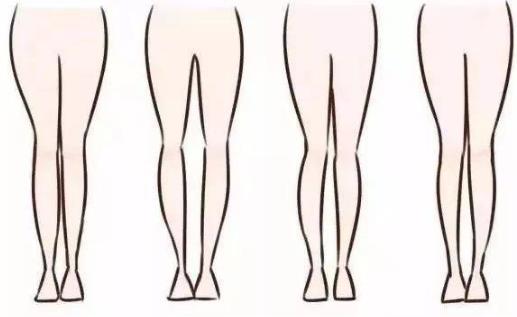 O型腿不是靠綁就能拉直的 大腿紋不對稱家長要留神