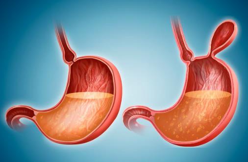 胃癌活動期的飲食禁忌 晚期胃癌患者的護理大全