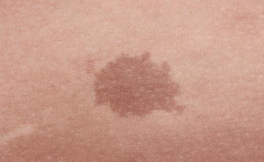 身上長這種顏色胎記竟暗藏殺機 小心胎記可能是疾病信號