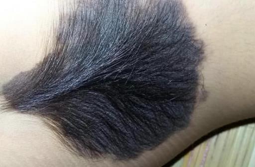 身上長這種顏色胎記竟暗藏殺機 小心胎記可能是疾病信號