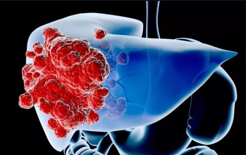 肝癌晚期的癥狀大揭秘 肝癌晚期手術切除是首選方案