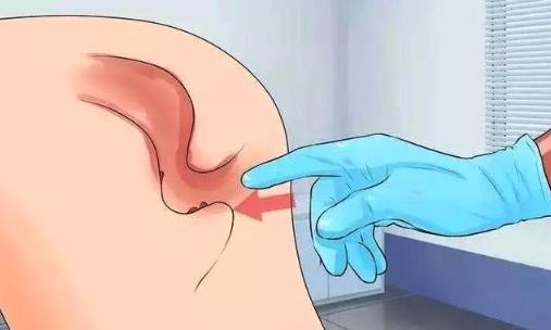 肛門潮濕是怎么回事?主要是這6大誘因在作怪