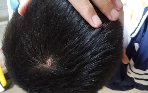 從外觀上判別粉瘤 粉瘤的預防及治療