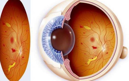 糖尿病也叫生活方式病 糖尿病患者治療期間注意事項(xiàng)