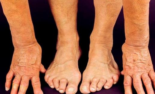 類風(fēng)濕患者越吃越健康的東西的天然療效，