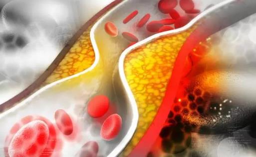 身上3處疼，可能是血管堵了！做6件事不給血管“添堵”