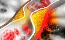 身上疼痛可能是血管堵了 細節養出健康不給血管添堵