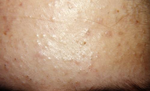 別在硬擠黑頭粉刺 教你即刻恢復干凈漂亮鼻頭