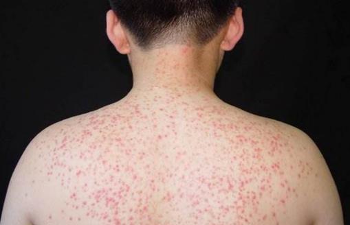 消除“雞皮疙瘩”，讓皮膚恢復光滑