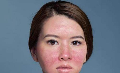 雙頰和鼻子泛紅，你可能得了玫瑰痤瘡