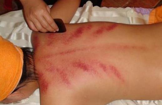 按摩之后進行刮痧效果好 刮痧不夠拔罐來救