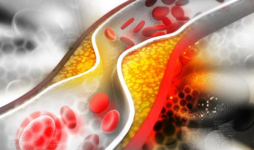 讓血管恢復(fù)“青春”的“保鮮劑” 你知道有哪些嗎?