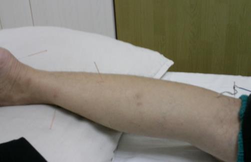 夏天是補(bǔ)腎好時(shí)機(jī) 中醫(yī)教你冬病夏養(yǎng)養(yǎng)出好陽氣