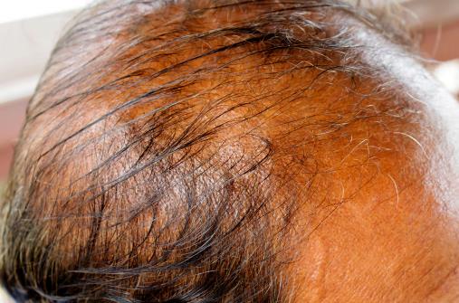 男人為什么會出現脫發 原因在這