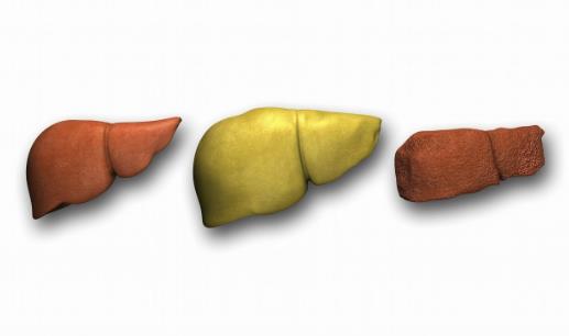 因為一件事，有人脂肪肝逆轉(zhuǎn)回正常，有人演變成癌！就怕