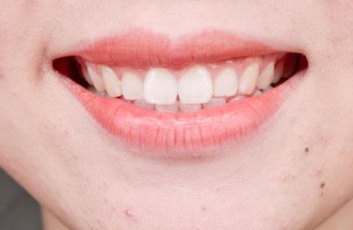 不建議用牙簽剔牙?看完四個后果,相信你不敢用牙簽剔牙