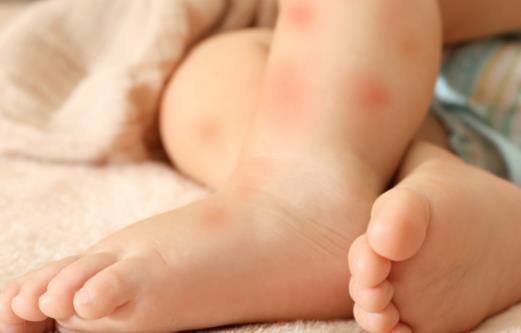 生理鹽水治皮膚過(guò)敏嗎 單純用鹽水不恰當(dāng)