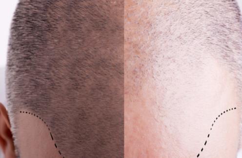 防止掉頭發除了食療還要做到這幾點