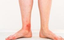 淤血體質調理食物有效祛瘀 保持心情舒暢作息規律