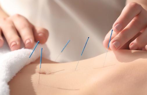 針灸減肥遠離6誤區針灸減肥的穴位常用