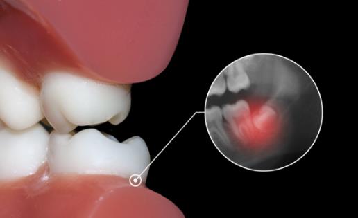 不良智齒應及時拔掉 不需要拔智齒的三種情況