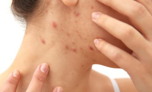 日常護膚避開去粉刺的護膚誤區 去粉刺的方法大全